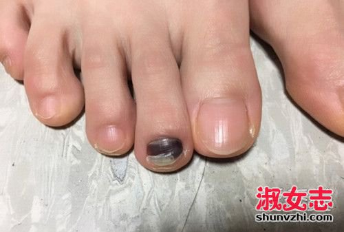 指甲里出现一块黑色的东西 脚趾甲变黑原因